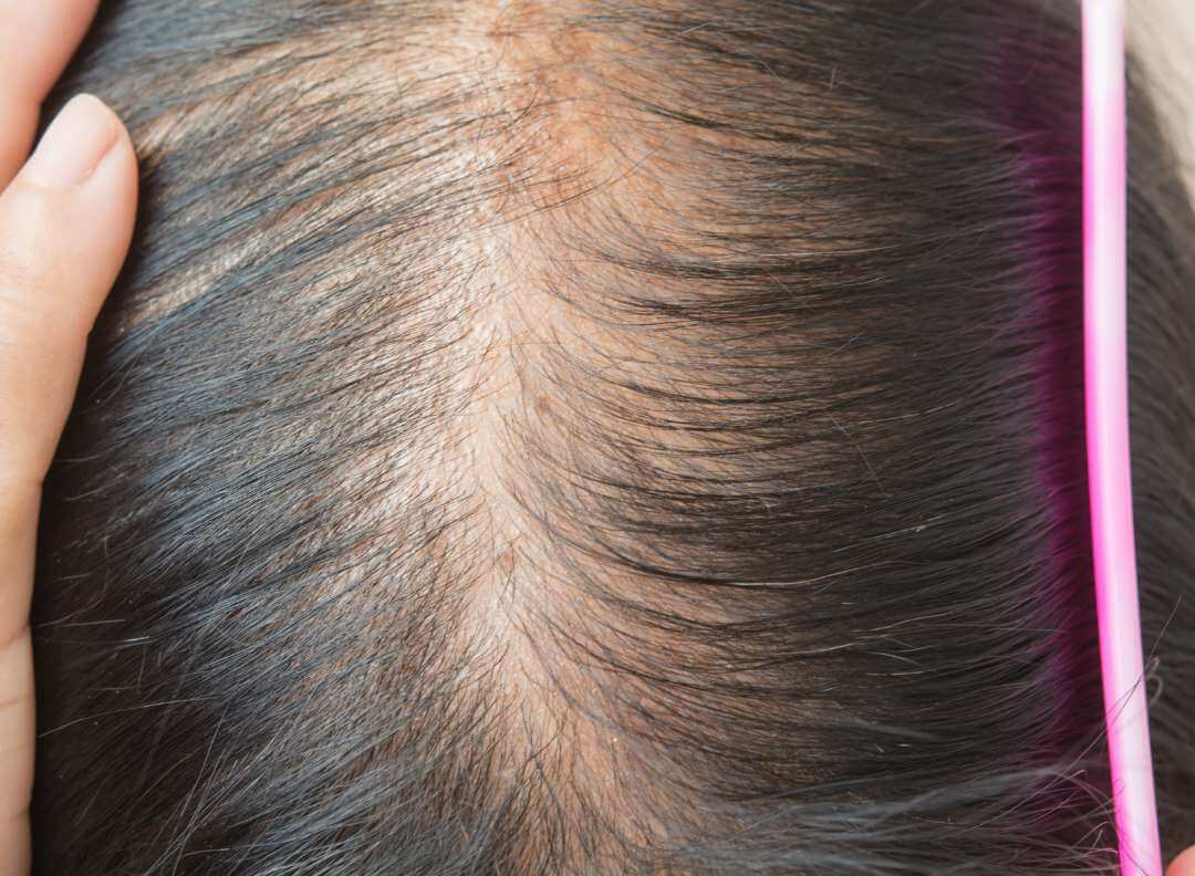 iron-hair-loss-thinning top view of woman's scalp, with thinning hair
